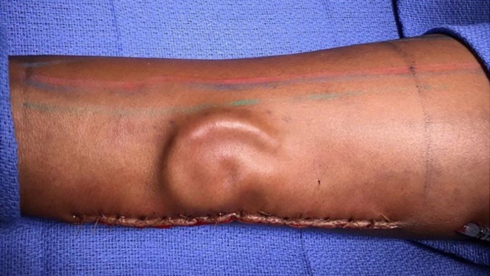 Le hicieron crecer una oreja en el brazo y se la trasplantaron a la cabeza