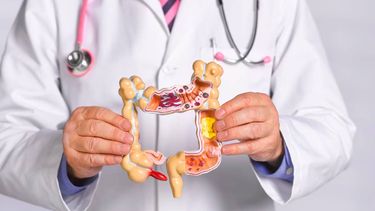 Cáncer de Colon: hay más de 15.000 casos nuevos por año en Argentina Cáncer de Colon: hay más de 15.000 casos nuevos por año en Argentina