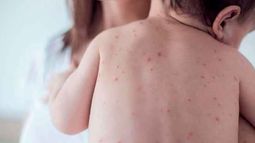 Nuevo caso de sarampión en Entre Ríos: se reactiva el alerta nacional