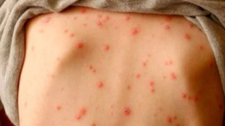 Erupción cutánea provocada por el sarampión. /Imagen ilustrativa