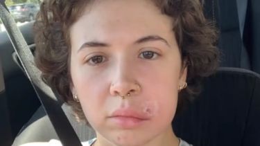 La joven terminó en el hospital después de intentar eliminarse el grano.