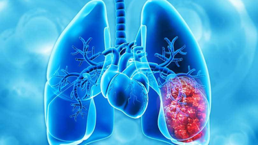 Enfermedad Pulmonar Obstructiva Crónica -&nbsp; Foto de archivo&nbsp;