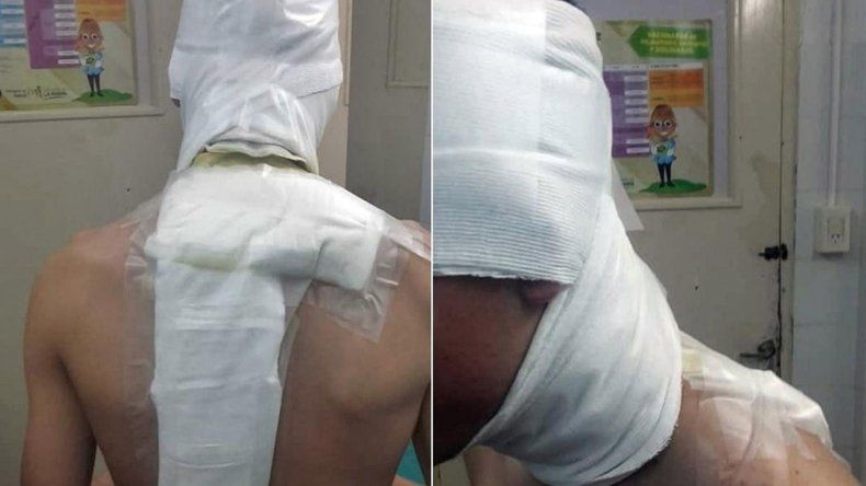Fútbol salvaje: le tiraron agua hirviendo a un jugador y terminó en el hospital
