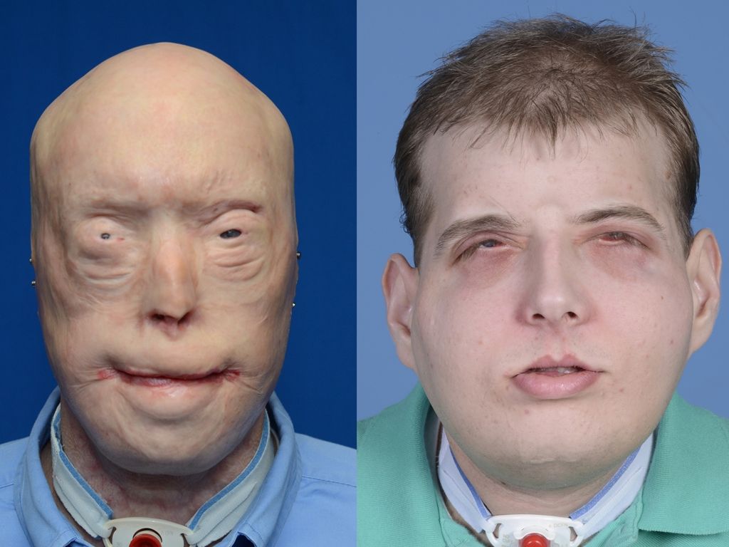 Hombre con trasplante de cara