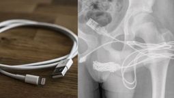 A un joven se le atascó un cable USB en el pene.&nbsp;