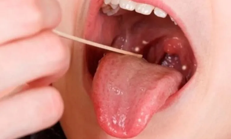 Streptococcus pyogenes.