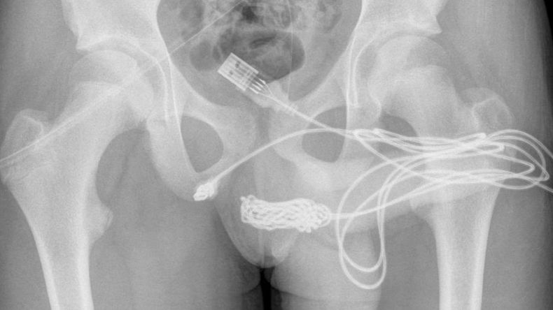 Los médicos de Urgencias registraron un caso singular cuando un adolescente trató de medir la longitud de su pene utilizando un cable USB.&nbsp;