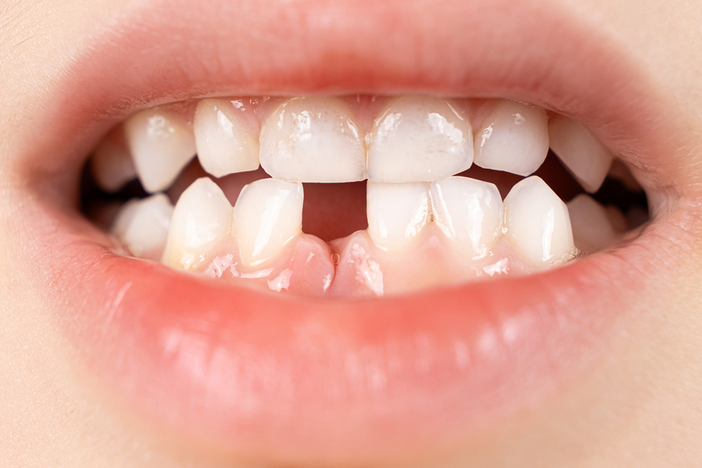 Dientes de leche.
