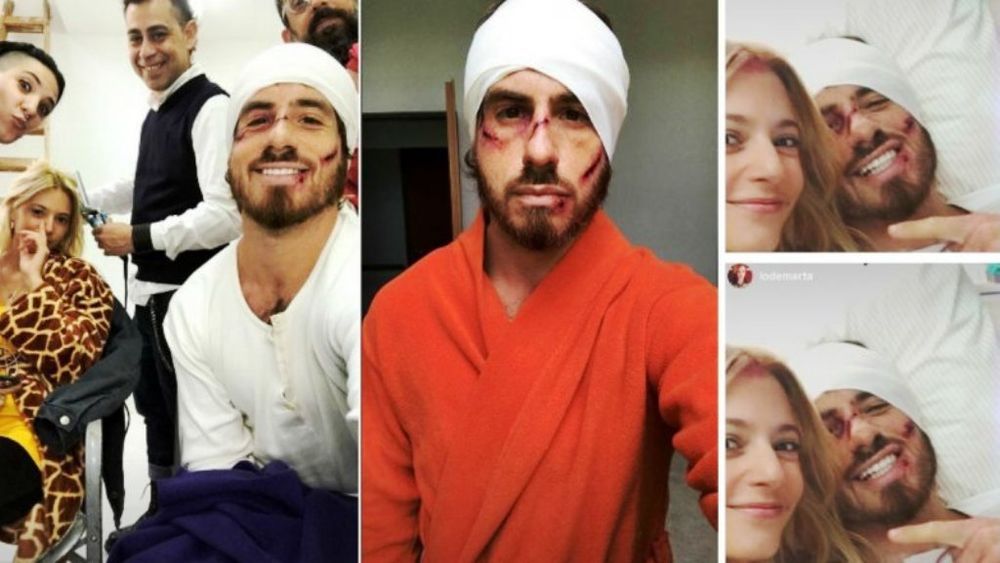 Federico Bal se fotografió golpeado, ¿qué le pasó?