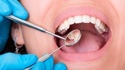 Trucos y recomendaciones para prevenir las caries.&nbsp;