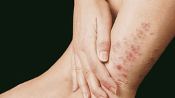 Alerta en Jujuy por los casos de lepra y chikungunya en Salta: consejos y advertencias