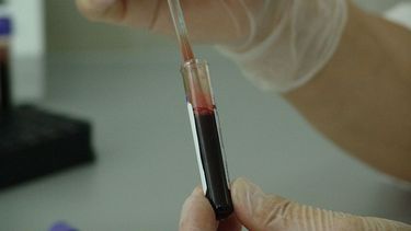 Un simple test de sangre podría permitir detectar varios tipos de cáncer de manera temprana.