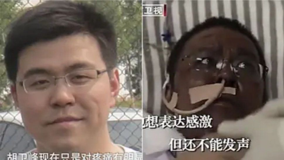 China: Murió uno de los médicos con COVID-19 que cambió el color de piel