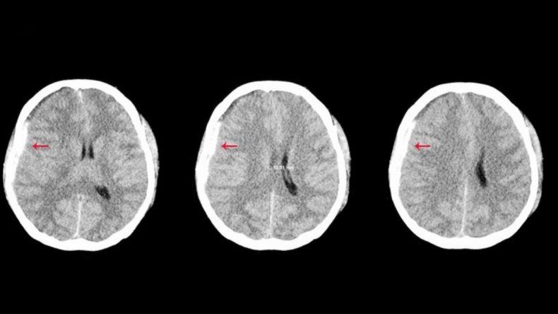 Imagen de un hematoma subdural.