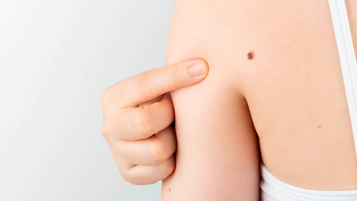 en argentina se diagnostican por ano mas de 1.600 casos de melanoma