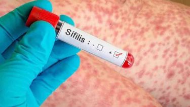 Más contagios de sífilis en Argentina (Foto ilustrativa) Más contagios de sífilis en Argentina (Foto ilustrativa)