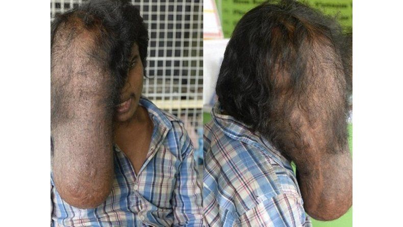 El tumor será extirpado