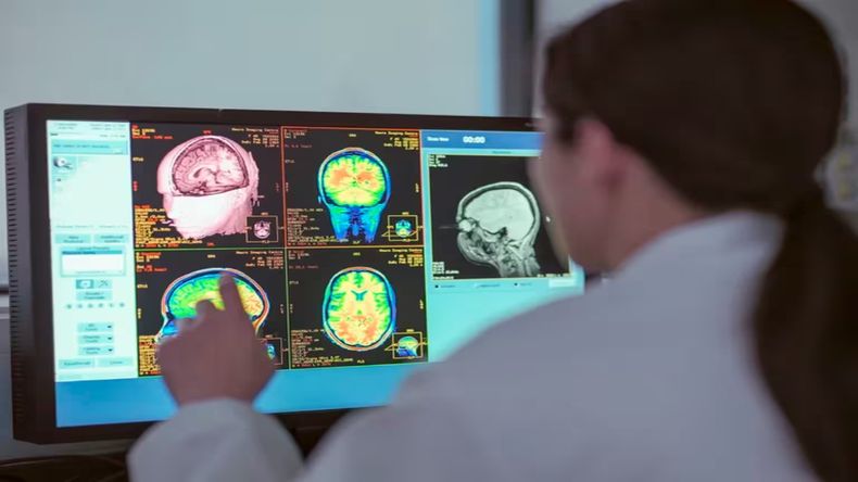 El Alzheimer provoca deterioro cognitivo progresivo, vinculado entre otras cosas a la acumulación de proteína beta amiloide.