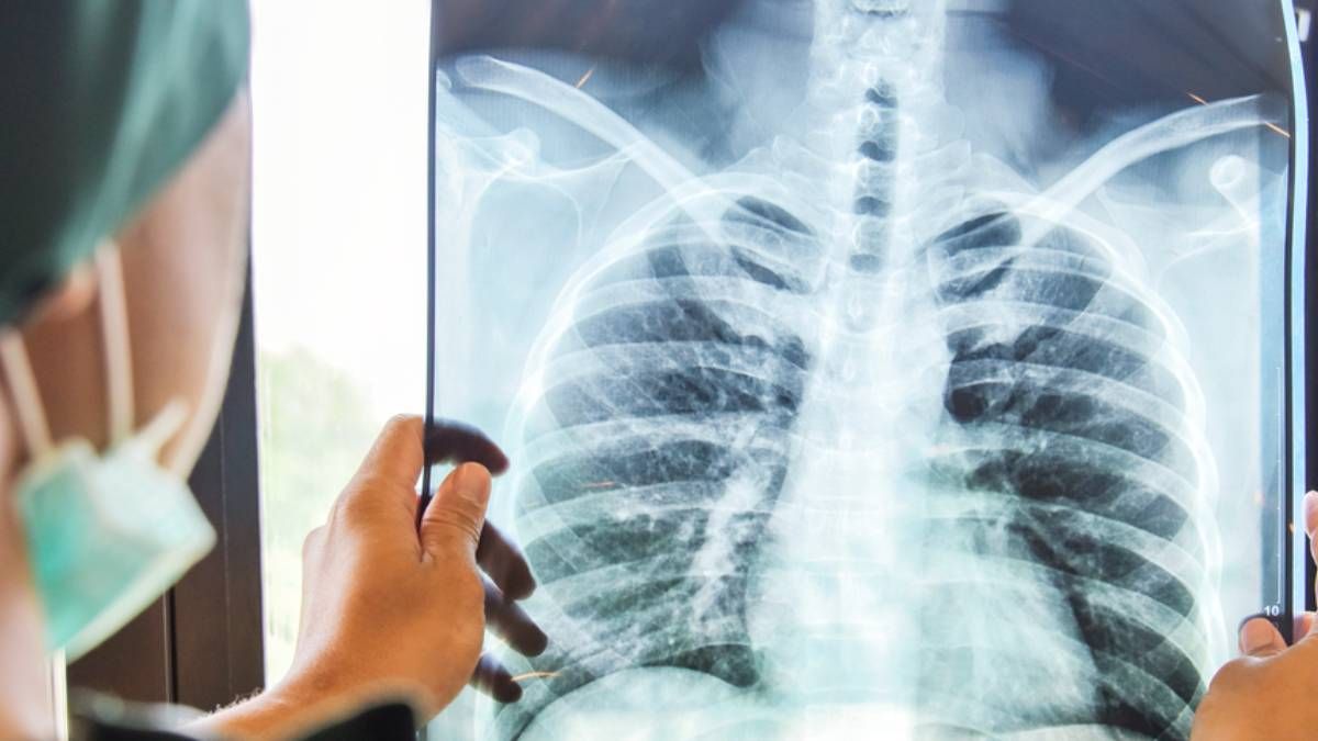 Tuberculosis en el NOA: Jujuy y Salta, bajo la lupa sanitaria