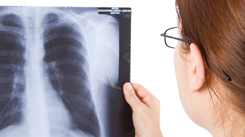 Caso de tuberculosis en Jujuy: es sumamente importante un diagnóstico rápido.
