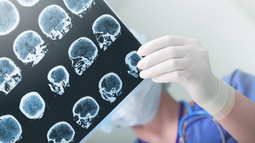 epilepsia:“Las crisis epilépticas por definición son eventos repetitivos estereotipados”,
