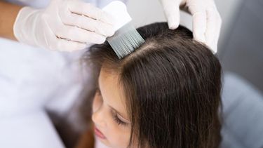Piojos en niños: cómo evitar el contagio y las recomendaciones