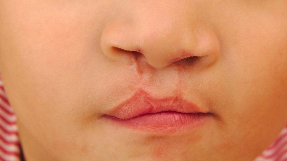 de 19 a 25 casos anuales en jujuy: fisura de labio alveolo palatina