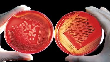 Listeriosis: de qué se trata la enfermedad causada por la bacteria detectada en un queso que alertó al Ministerio de Salud.
