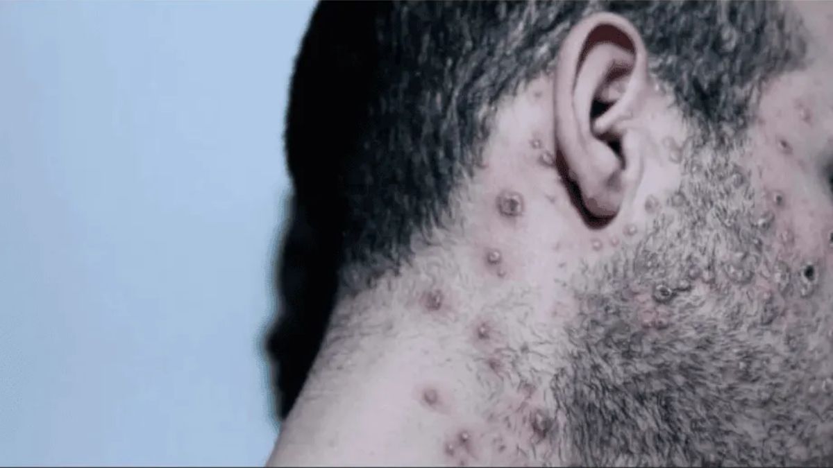 Según el estudio, El 95% de los casos de viruela del mono se transmitió a través de actividad sexual.