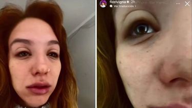 La increíble alergia que le salió a Flor Vigna que preocupó a sus fans.&nbsp;