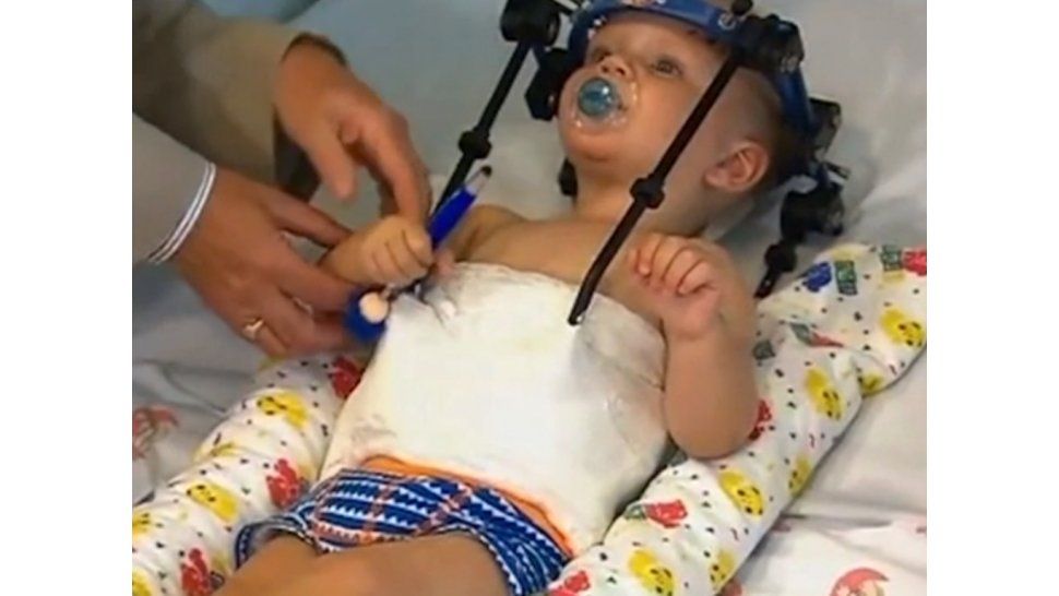 Niño que sufrió decapitación interna