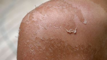 Un dermatólogo explicó por qué en Jujuy el sol es más riesgoso para la piel