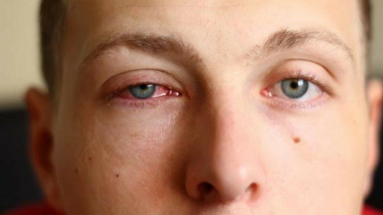 Confirman 10 atenciones diarias por un brote de conjuntivitis