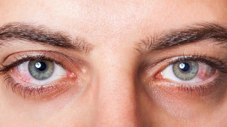 Existen pacientes que, durante el proceso del coronavirus, presentan conjuntivitis.
