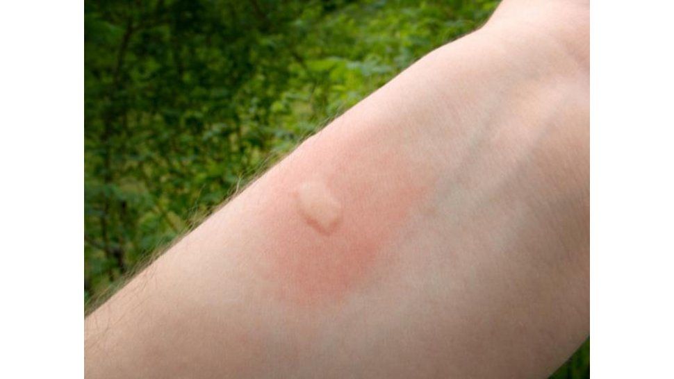 Picadura de mosquito