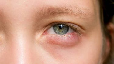 Cómo desinflamar los ojos rápidamente: tips y consejos