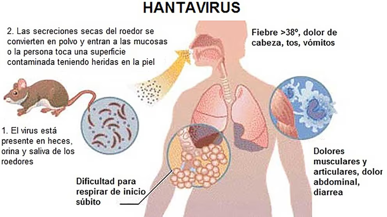 Alerta Hantavirus: Si bien se transmite al inhalar aire contaminado con las secreciones de los roedores o al tocarlos, en Argentina surgió un brote atípico que se produce cuando una persona infectada entra en contacto estrecho con otra Alerta Hantavirus: Si bien se transmite al inhalar aire contaminado con las secreciones de los roedores o al tocarlos, en Argentina surgió un brote atípico que se produce cuando una persona infectada entra en contacto estrecho con otra