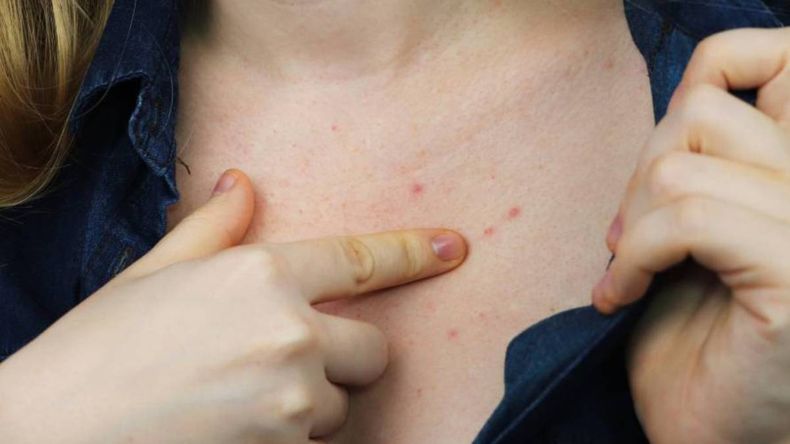 Sarna, síntomas y formas de prevención