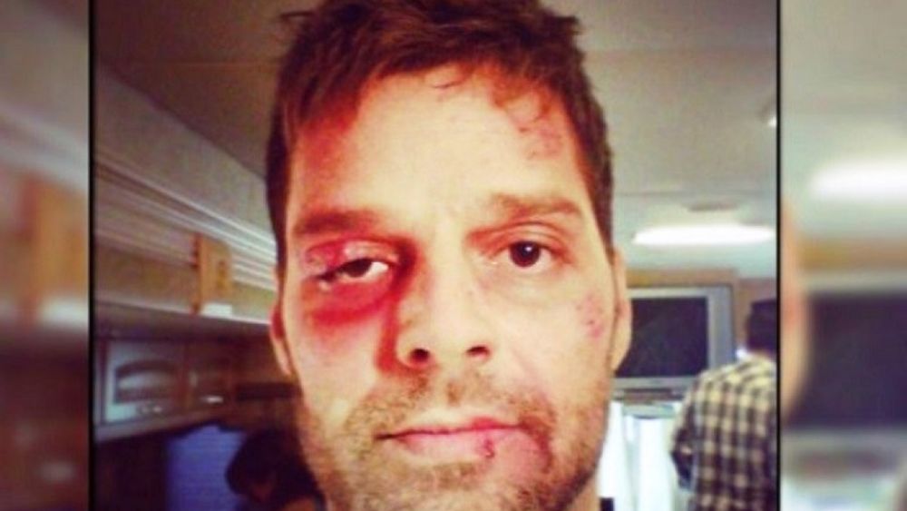 Ricky Martin ¿golpeado?