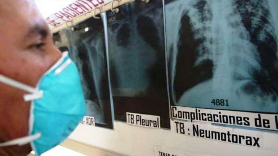 Tuberculosis: Jujuy se encuentra en una meseta, el año pasado se registraron 417 casos