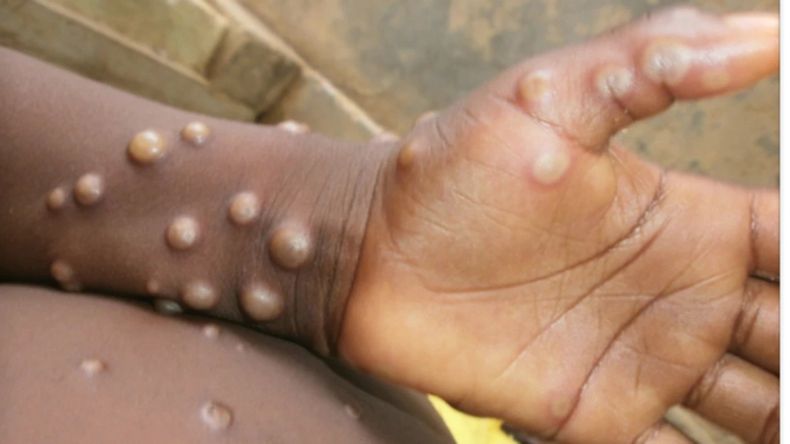 Los casos registrados de la viruela del mono hasta el momento no tienen vínculos de viaje establecidos con áreas endémicas en África.