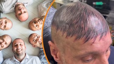 Viral: quedó pelado y se tatuó la cabeza para disimular.&nbsp;