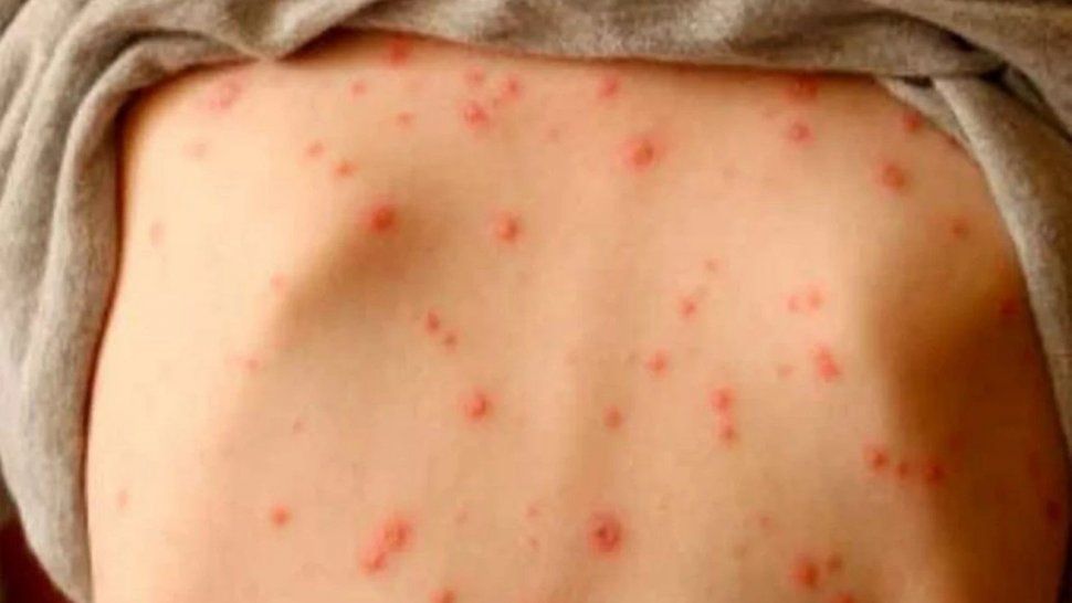 Erupción cutánea provocada por el sarampión. /Imagen ilustrativa