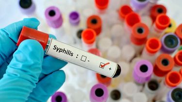 La etapa de sífilis latente o etapa oculta es un período en el que no hay síntomas visibles.