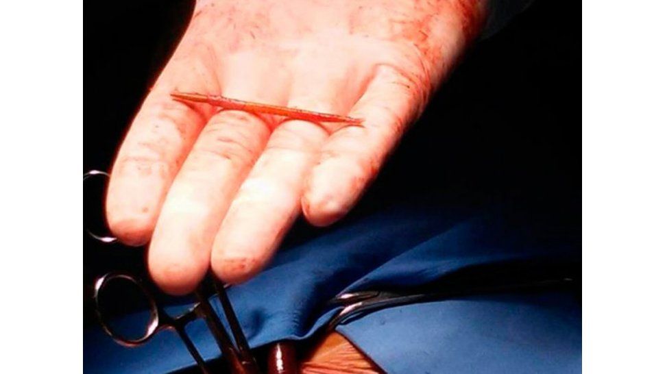escarbadientes encontrado en un corazón