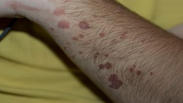 Se confirmaron dos casos de lepra en Orán, Salta.