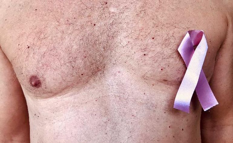 El cáncer de mama también puede aparecer en los hombres.