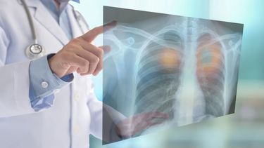 El 1 de agosto se conmemora el Día Mundial del Cáncer de Pulmón.