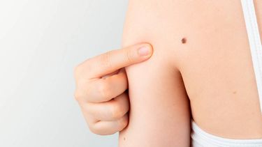 En Argentina se diagnostican por año más de 1.600 casos de melanoma