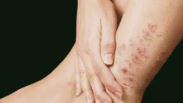 Alerta en Jujuy por los casos de lepra y chikungunya en Salta: consejos y advertencias Alerta en Jujuy por los casos de lepra y chikungunya en Salta: consejos y advertencias